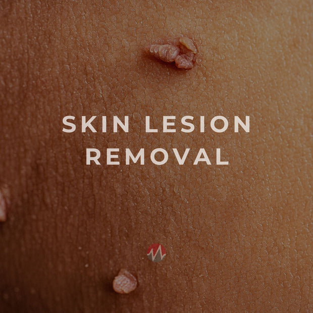 Skin Lesion Removal